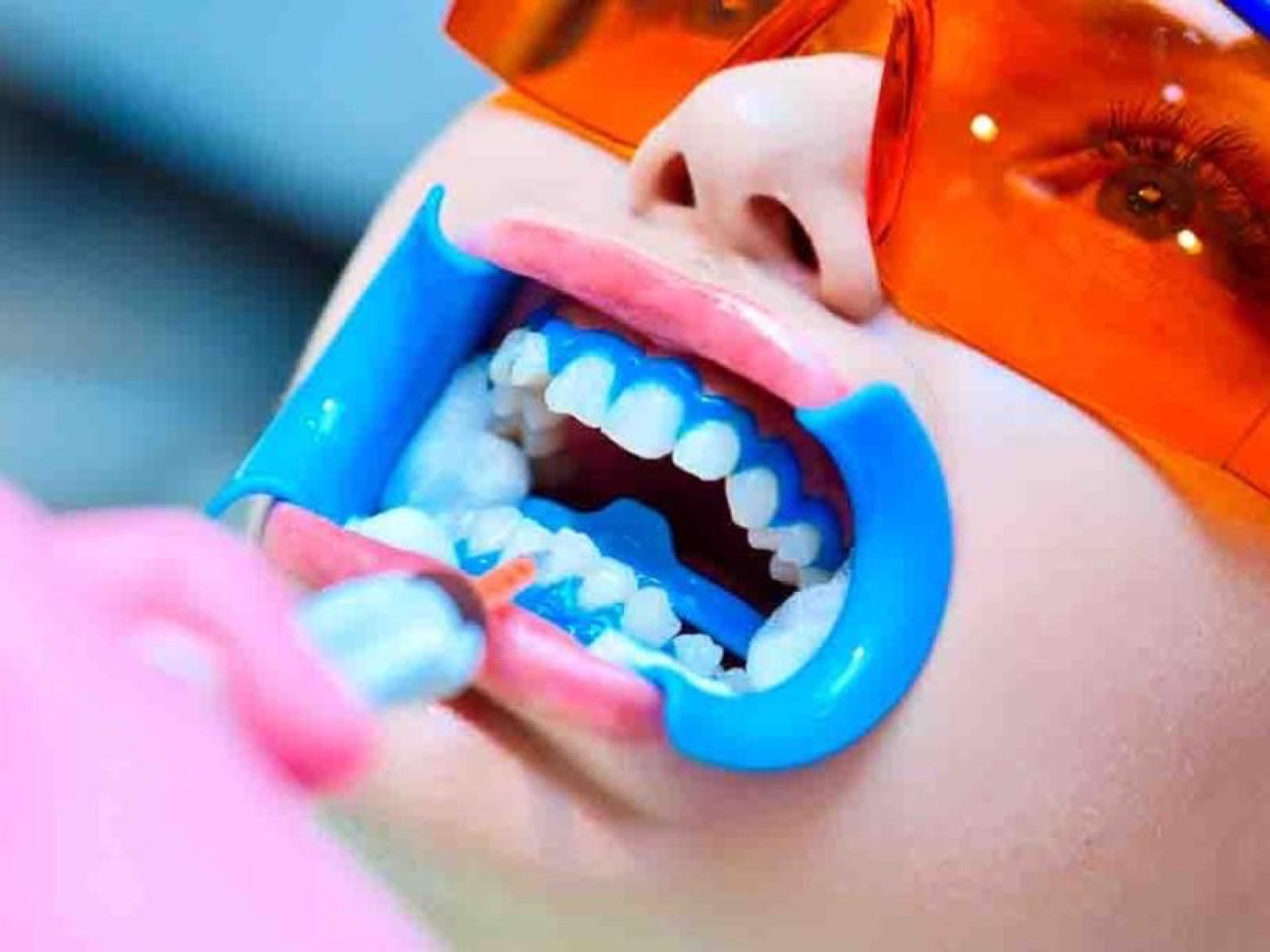 Clareamento dental